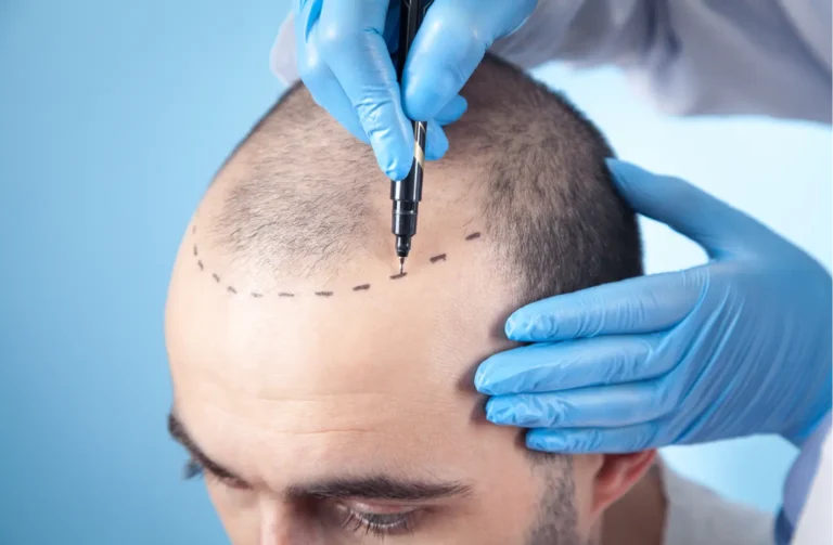 Hair Transplant Istanbul: A Comprehensive Guide to FUE Hair Transplant Timeline